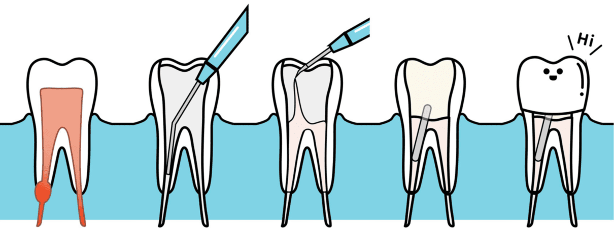 endodoncia postup